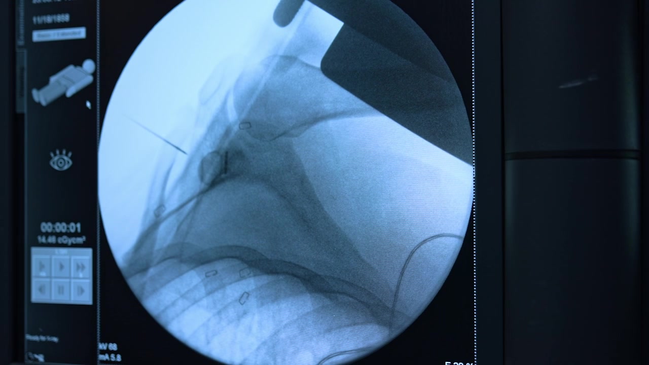 Radiografie di un paziente sotto intervento chirurgico. Immagini dell'articolazione della spalla sui monitor delle apparecchiature mediche.