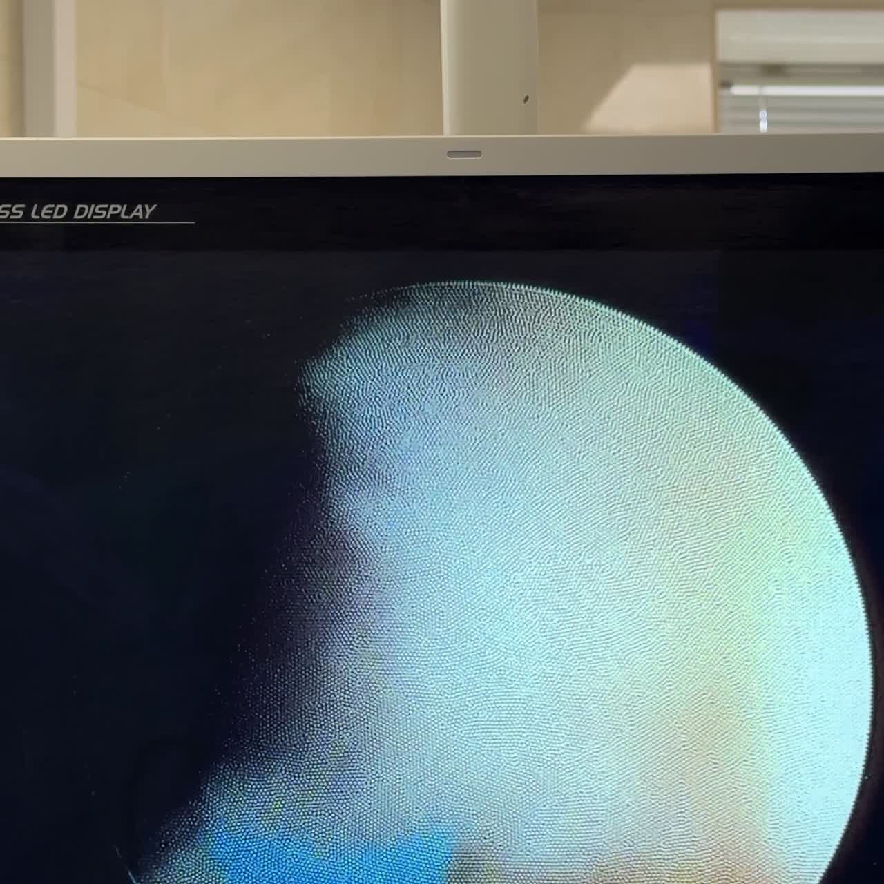 Chirurgia endoscopica dall'interno visualizzata sul monitor nella sala operatoria. Attrezzatura che supporta l'operazione in un moderno ospedale. Primo piano. Schermo verticale