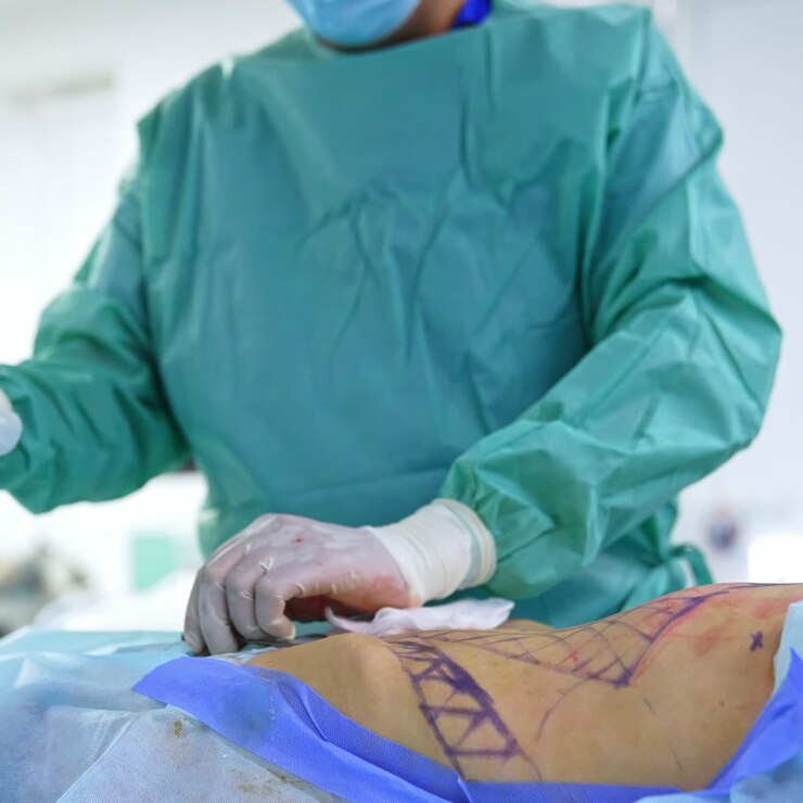 Un chirurgo plastico cambia la siringa durante un'operazione. Primo piano sul processo di liposuzione della zona addominale