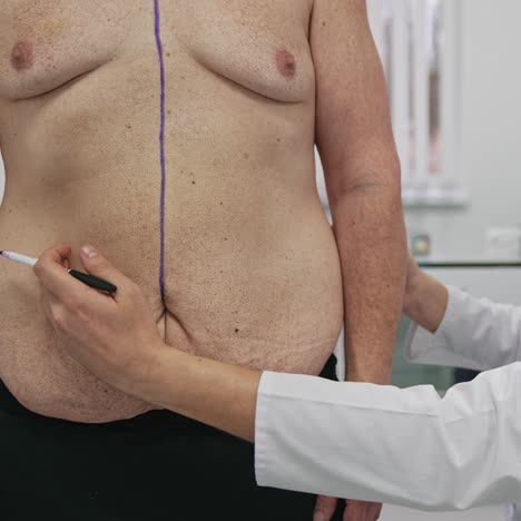 doctor prepares man for plastic surgery. male surgeon makes markings on patient's body before surgery. liposuction in clinic