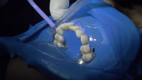 dental procedure of teeth cleaning during surgery as water is expertly inserted by the dentist