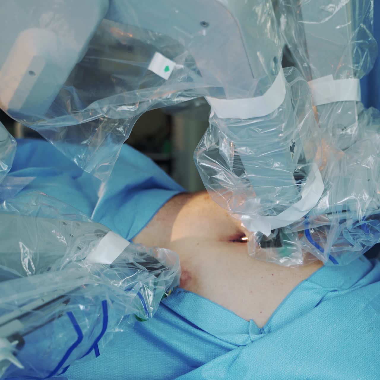 Robotic surgery. Medical operation by surgeon with the help of robot in the operating room. Modern technology with robotic device. Close-up.