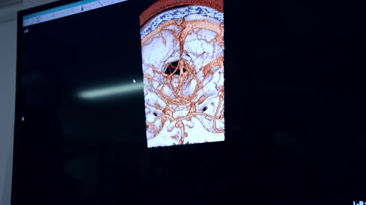 Scansione di dissezione aortica sul monitor dell'apparecchiatura medica. Primo piano. Preparazione per intervento neurologico.