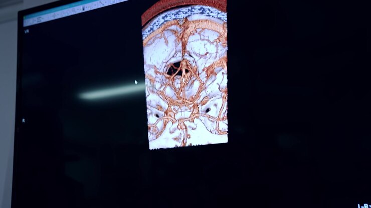 Scansione di dissezione aortica sul monitor dell'apparecchiatura medica. Primo piano. Preparazione per intervento neurologico.