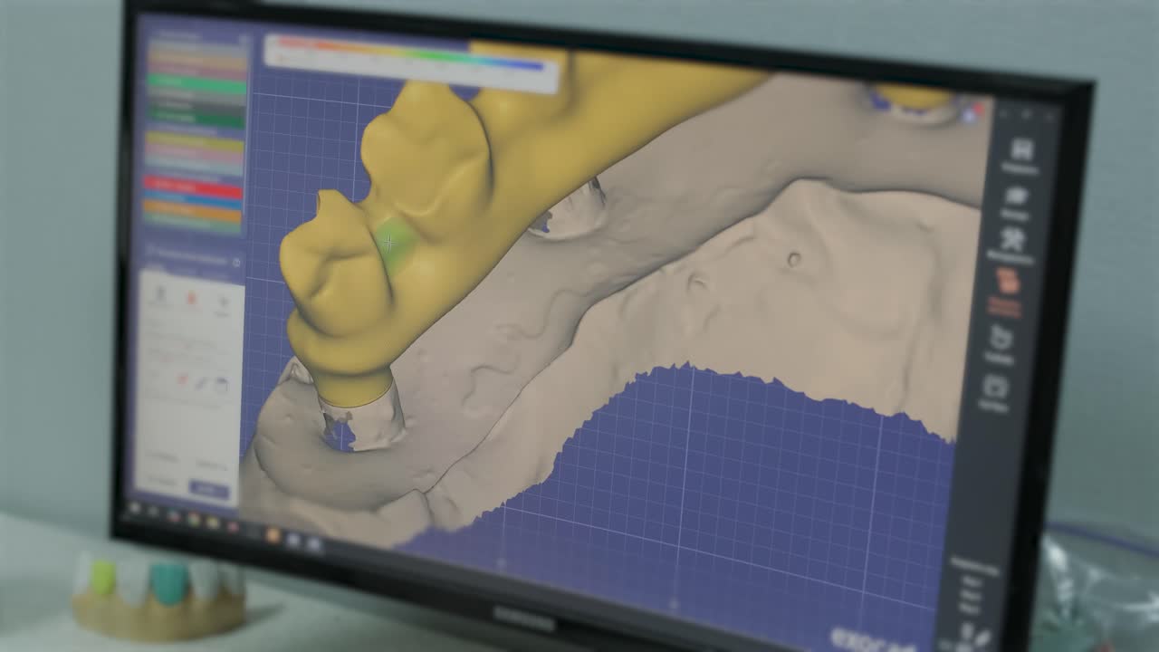 CNC Machine Cutting Zirconia Crowns from Unfired Zirconia