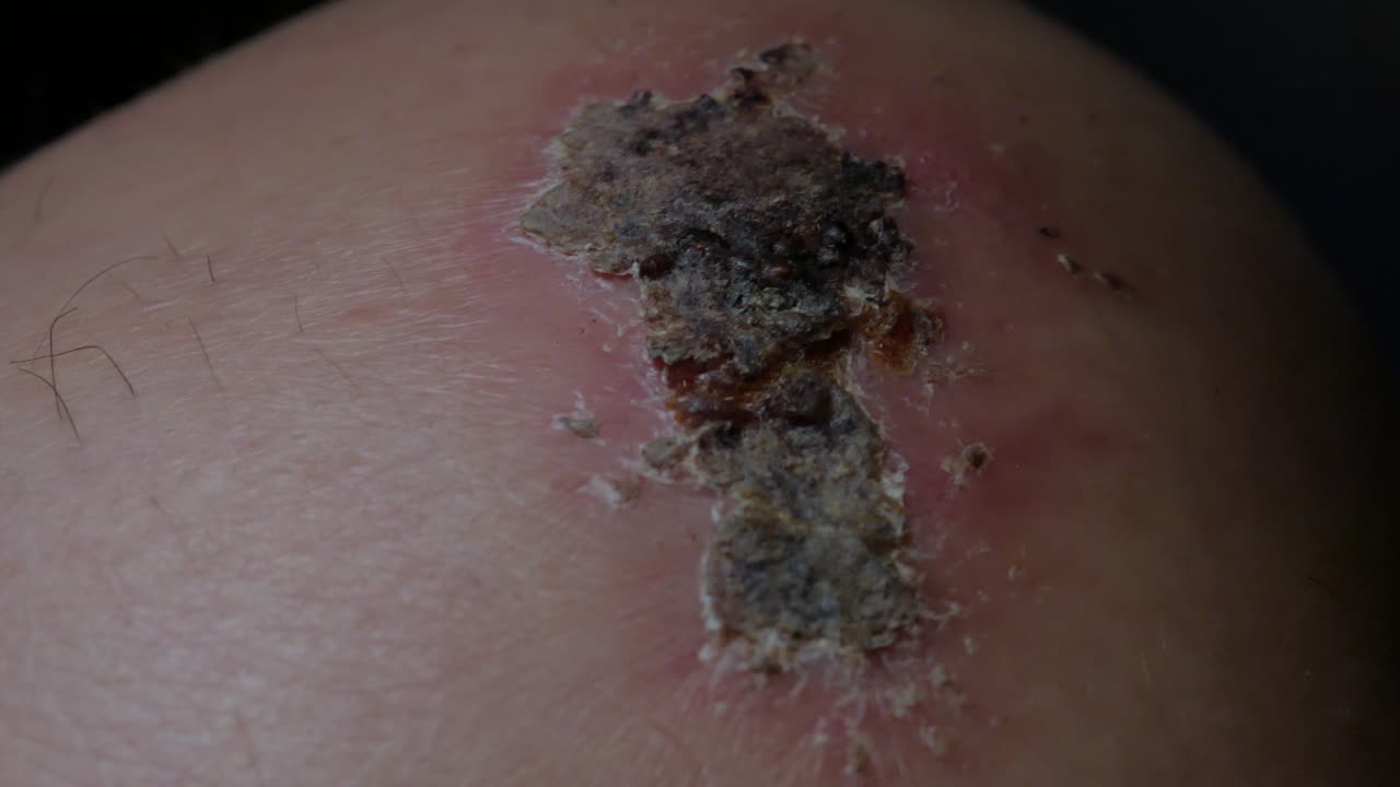 A very close up shot of a scab on a knee