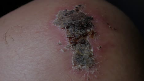 a very close up shot of a scab on a knee