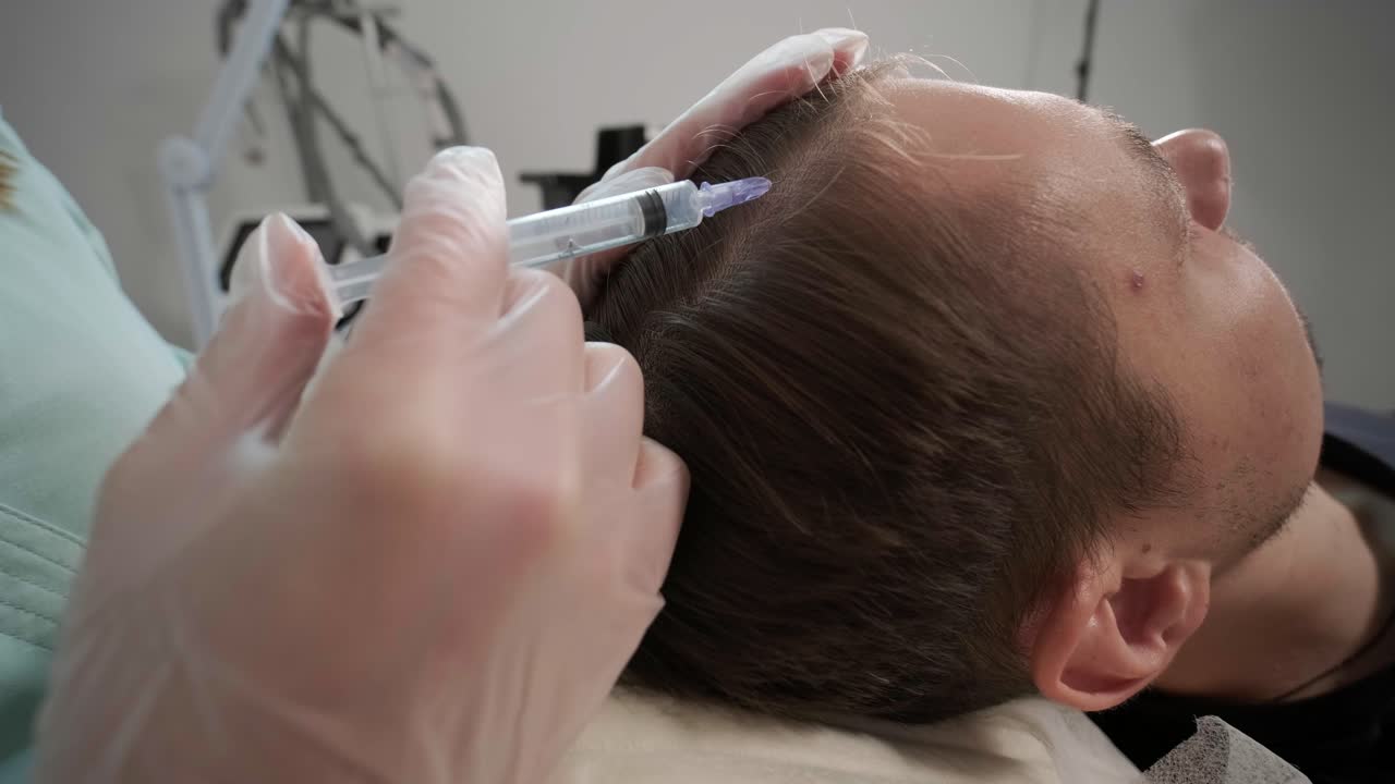 procedimiento de mesoterapia capilar en la clínica de cosmetología moderna