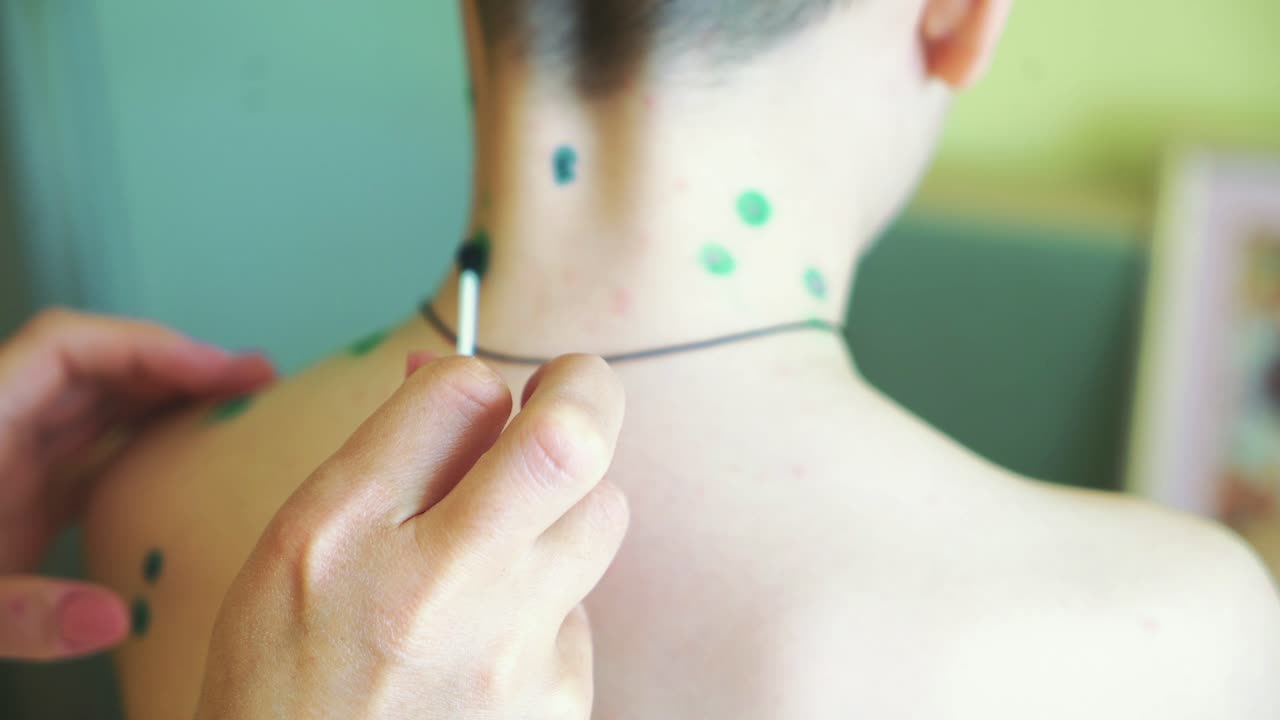 Little boy with chickenpox. Mother applying antiseptic solution to rash. Home treatment.