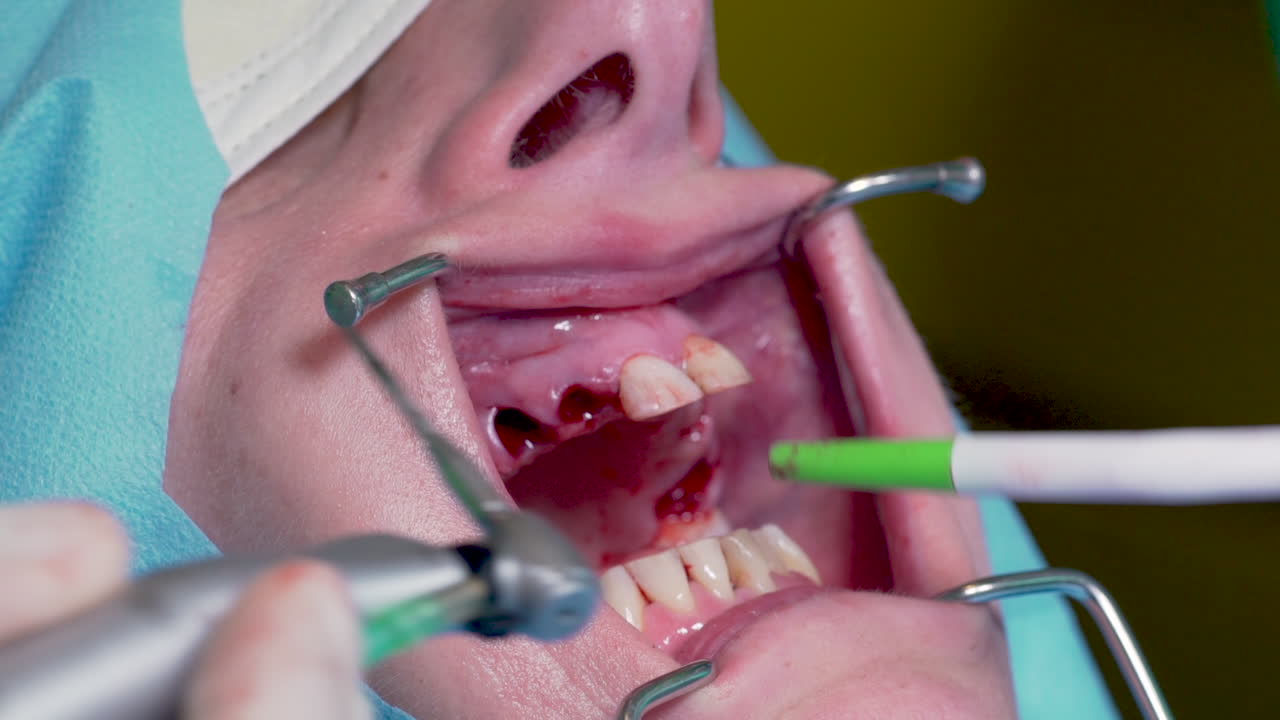 A woman getting all her teeth pulled out at the dentist