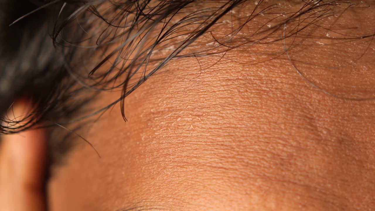 Close-up of Sweaty Forehead