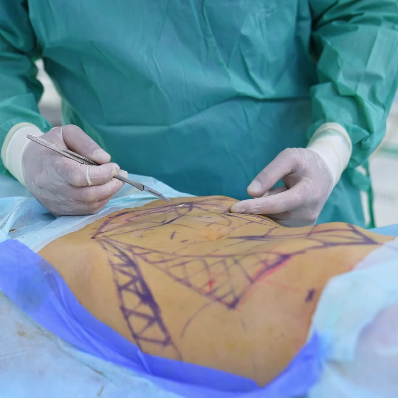 Patient with naked belly and applied lines lies on the surgery table. Doctors hands holding a scalpel start the operation making the cut