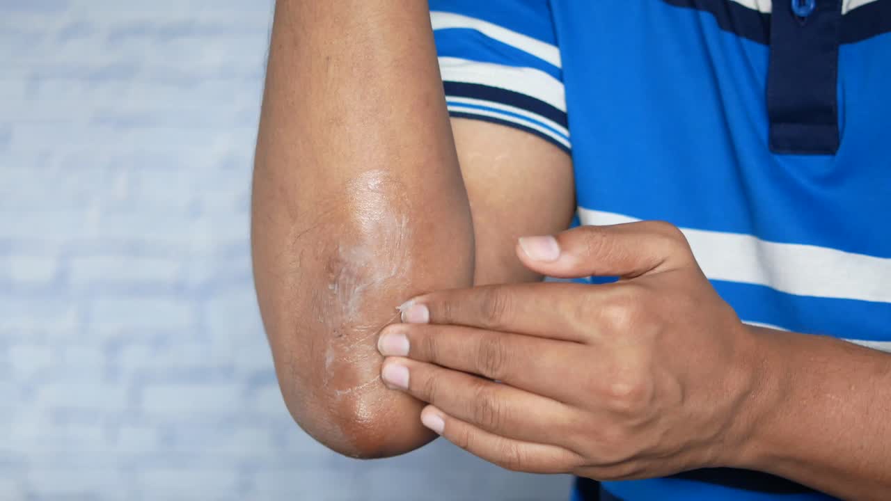 aplicación de crema en el codo