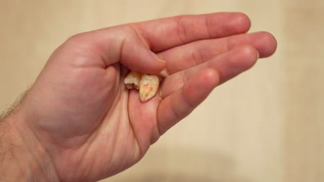 Dentist holds two wisdom teeth with big curved roots in hand, showing to camera