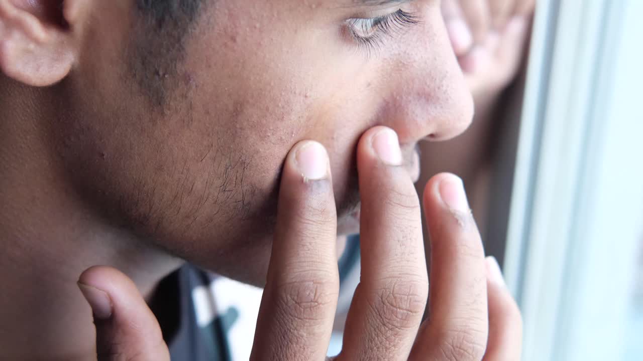 Primo piano di una persona con acne che si tocca il viso