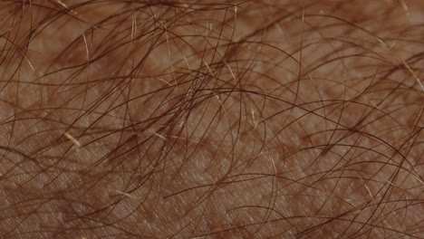 macro disparo de pelos en la piel caucásica que muestra una pérdida extrema, incluido el canal de la raíz del cabello