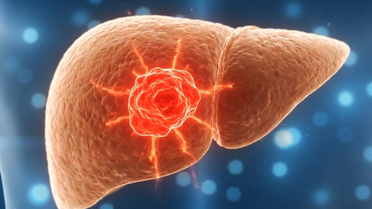 Animazione medica 3D della crescita del tumore epatico