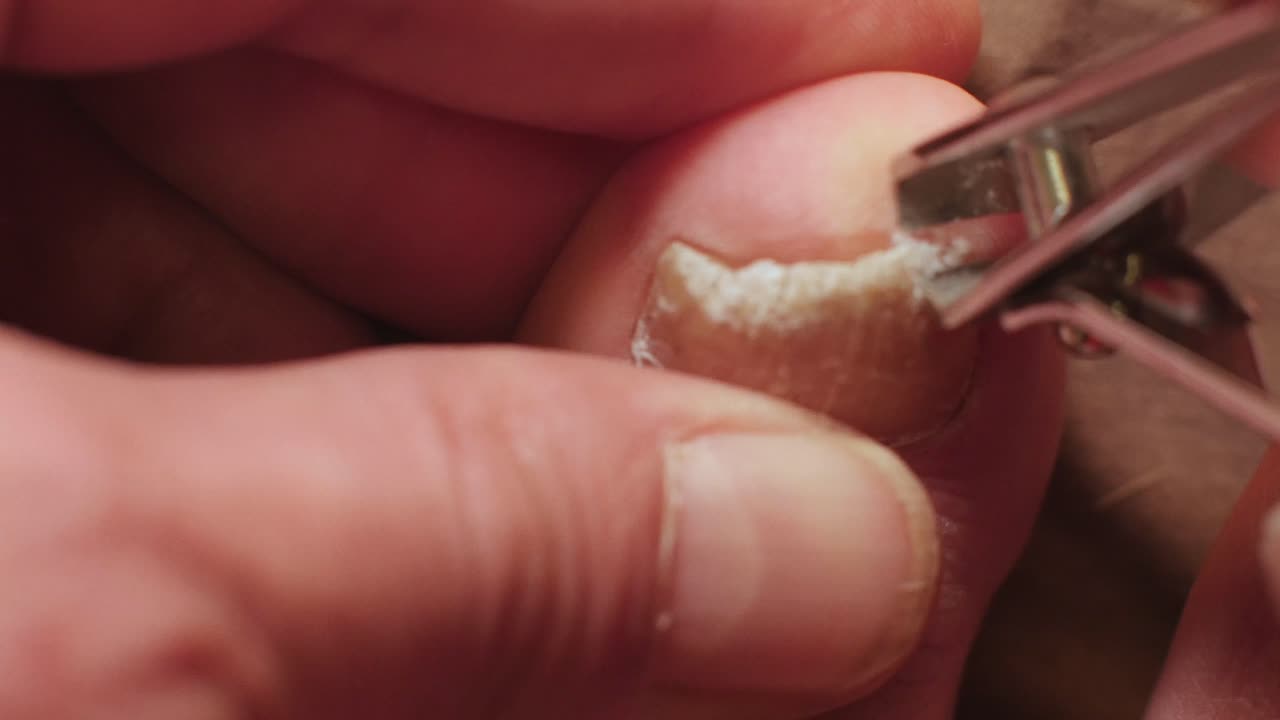 Cortando pedaços quebradiços de unha do pé com micose