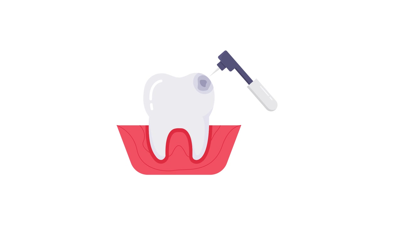 Animated Illustration of Dental Drill Treating a Tooth Cavity