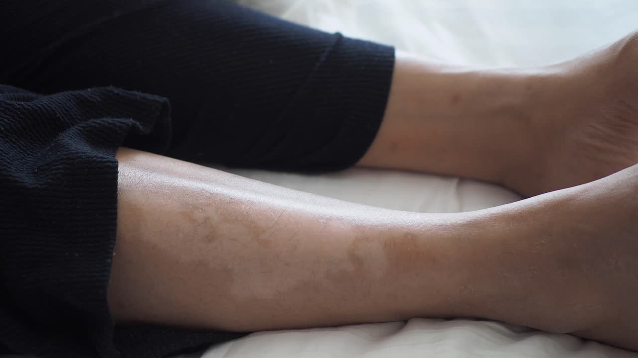 왼쪽 다리에 터가 있는 여자의 다리의 클로즈업