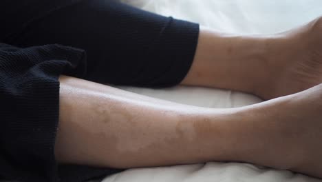 close-up of a woman's legs with a scar on her left leg