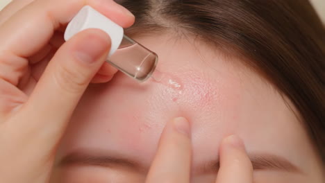 applying serum to treat acne on forehead