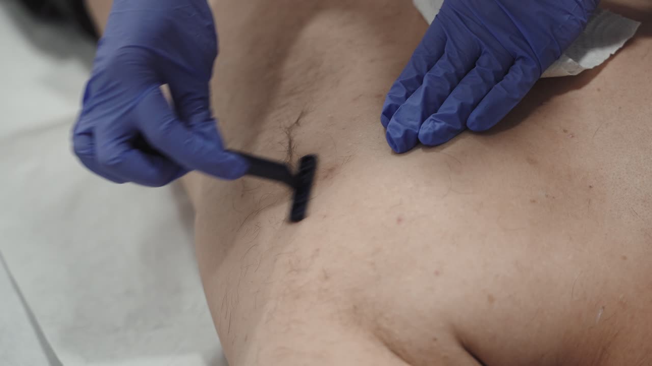 레이저 치료 전에 남자의 허리를 면도합니다.