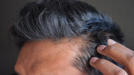 male pattern hair loss: close-up view of receding hairline and thinning hair