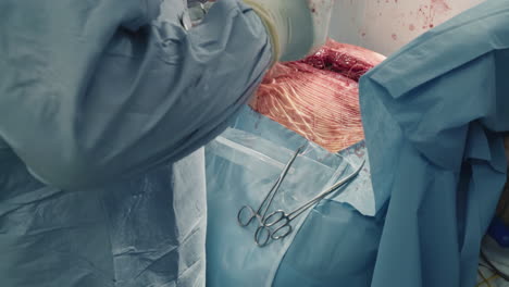 surgical team closes chest incision. cardiothoracic surgeons with assistant connect sides of cavity using sutures after coronary artery bypass surgery