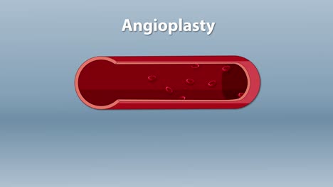 illustration of balloon angioplasty in artery