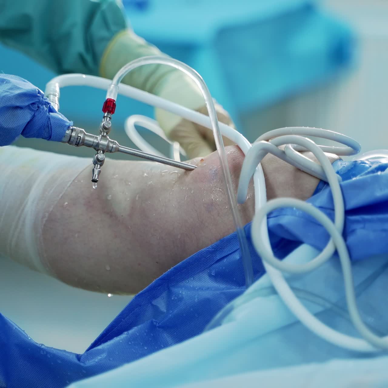 Guarigione di un trauma al ginocchio in una sala operatoria moderna. Il chirurgo ha inserito un dispositivo medico nella gamba del paziente. Primo piano