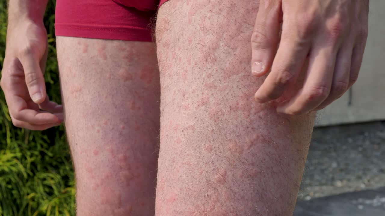 urticaria con picazón que se extiende por las piernas