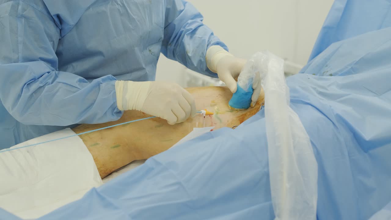 다리 양의 경우, 정맥 경화 치료를 위해 phlebology 절차에서 bioglue를 사용하여 정맥을 결합합니다.