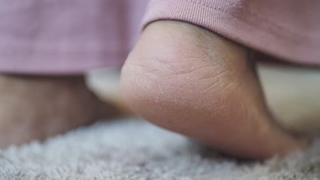 close-up of a person's cracked heel