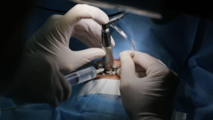 Laser vision correction. A patient and team of surgeons in the operating room during ophthalmic surgery. Eyelid speculum. Lasik treatment. Patient under sterile cover