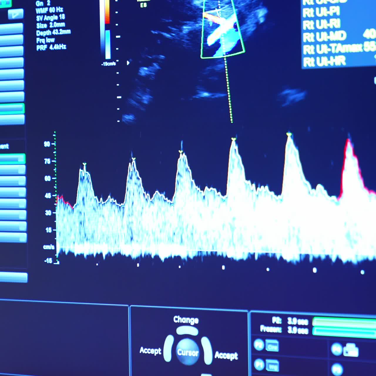 Screen of an ultrasound apparatus showing the inner of pregnant woman's abdomen. Monitor with baby development vital signs close up