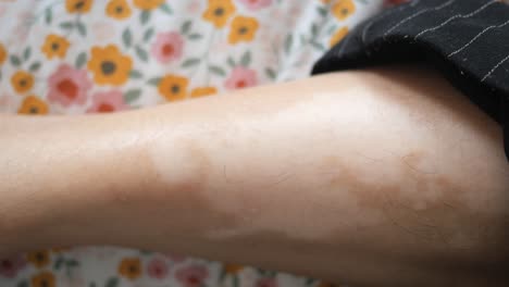 vitiligo: a skin depigmentation condition