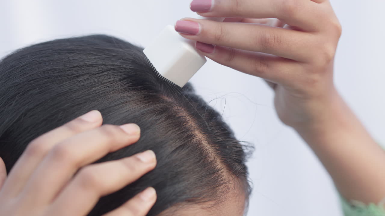 Crop view of an Indian young woman using derma stamp on her scalp to treat androgenic alopecia hairloss disease, microneedling treatment.