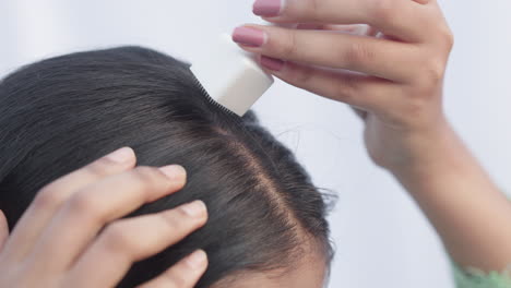 crop view of an indian young woman using derma stamp on her scalp to treat androgenic alopecia hairloss disease, microneedling treatment.