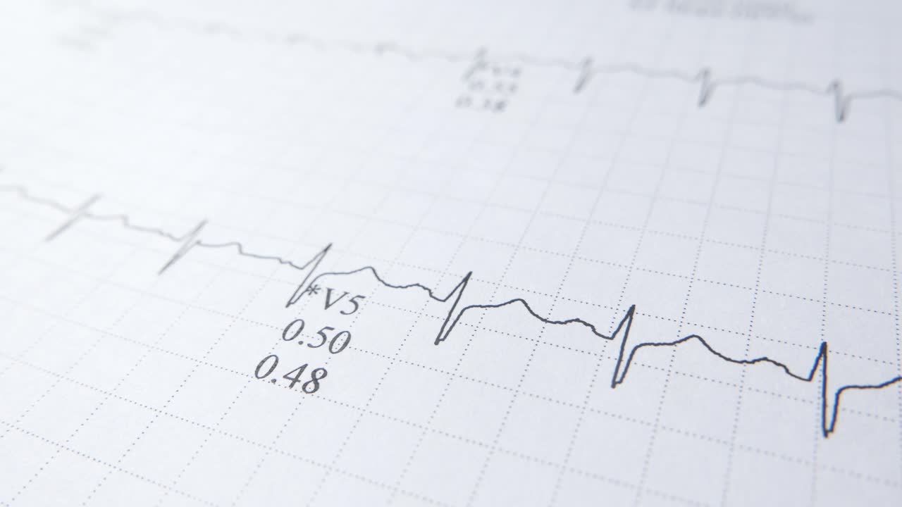 lectura de ecg: análisis de la forma de onda de los latidos cardíacos