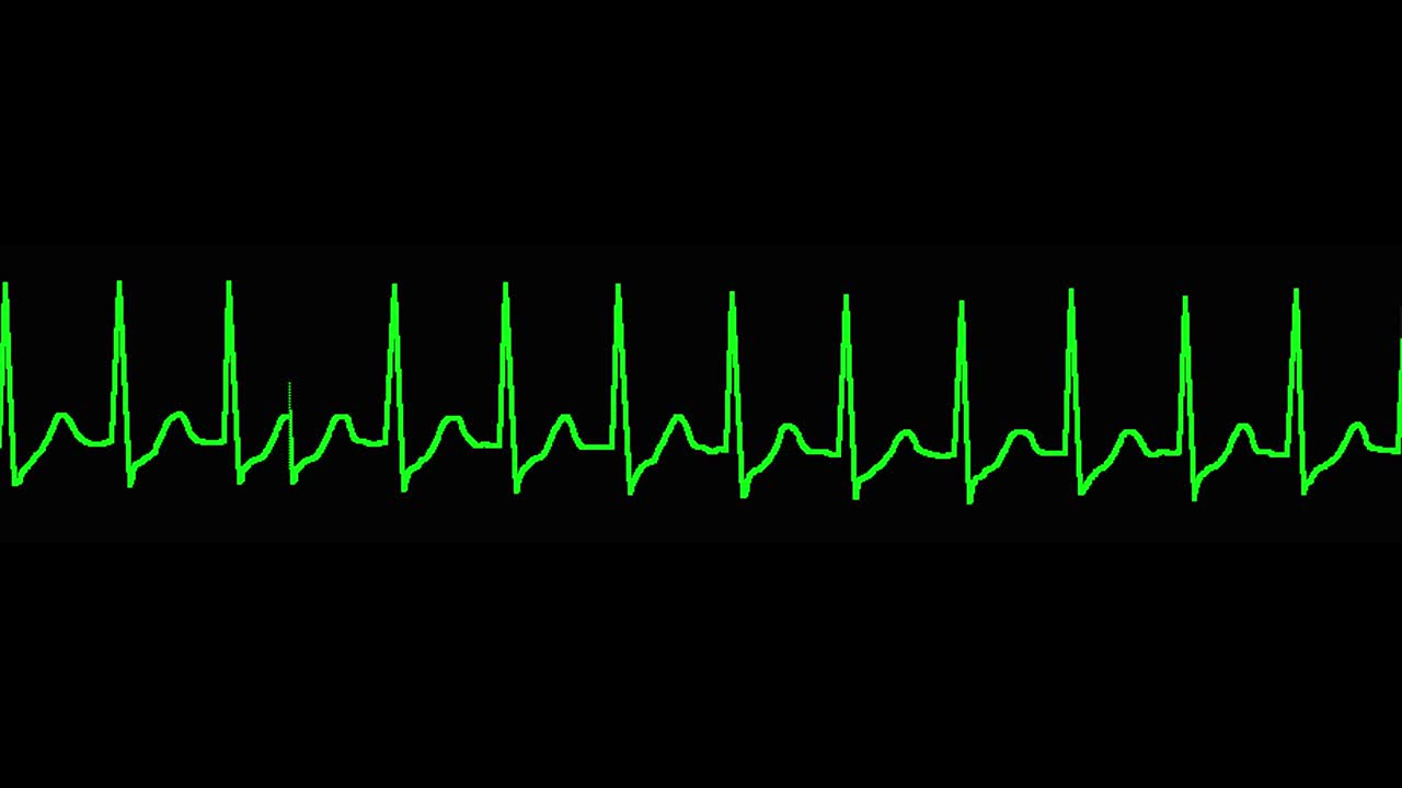 ecg shows paroxysmal supraventricular tachycardia (PSVT/SVT)