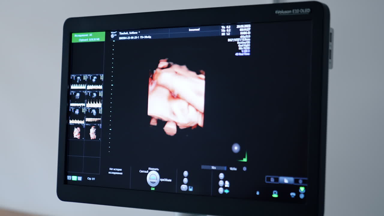 Prenatal image of a baby yet unborn on the monitor of ultrasound machine. Monitoring the pregnancy in hospital. Close up.