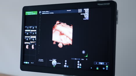 prenatal image of a baby yet unborn on the monitor of ultrasound machine. monitoring the pregnancy in hospital. close up.