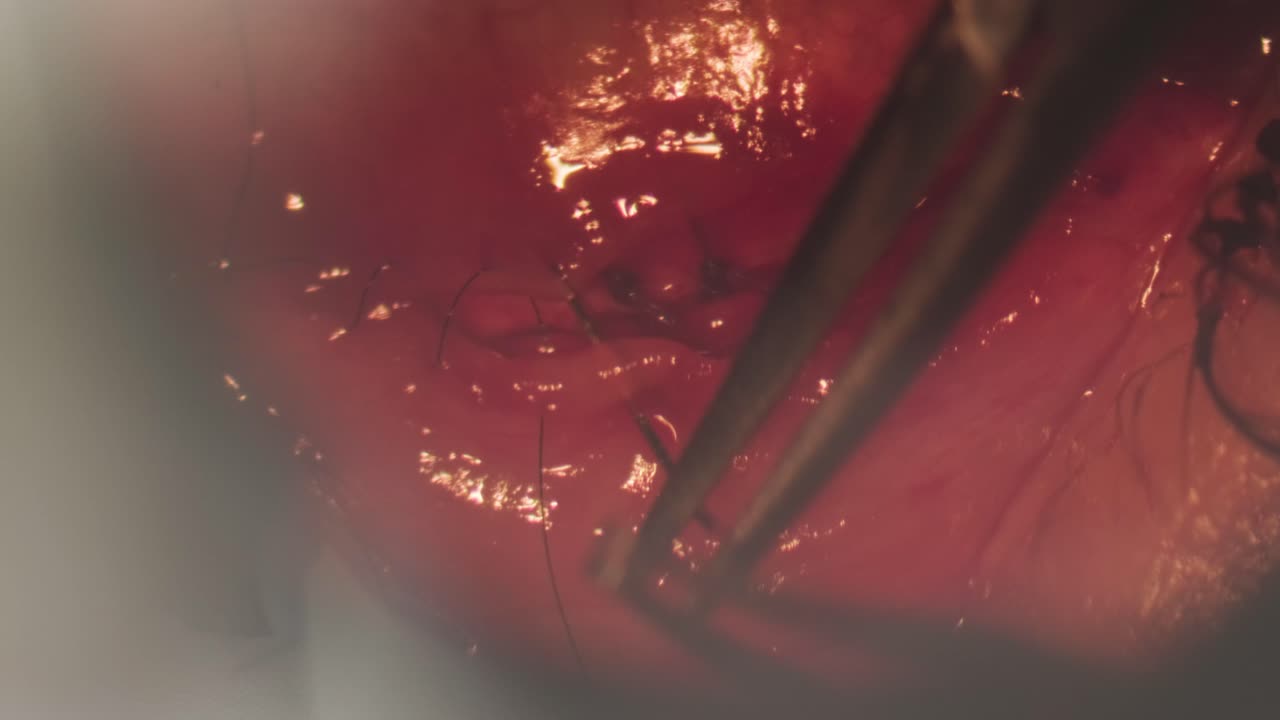 cirugía para corregir el estrabismo. vista a través de un microscopio. el cirujano cose el ojo. cirugía oftalmológica