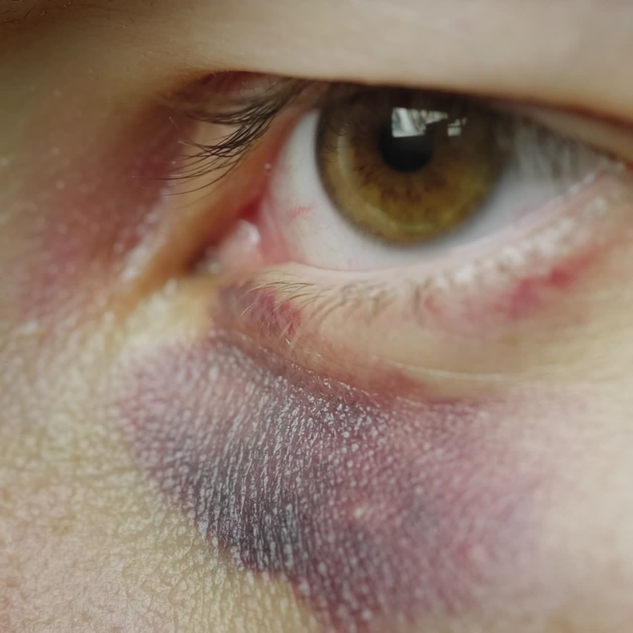 el ojo de un hombre con un hematoma y abrasiones 1