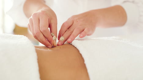 a therapist inserts acupuncture needles