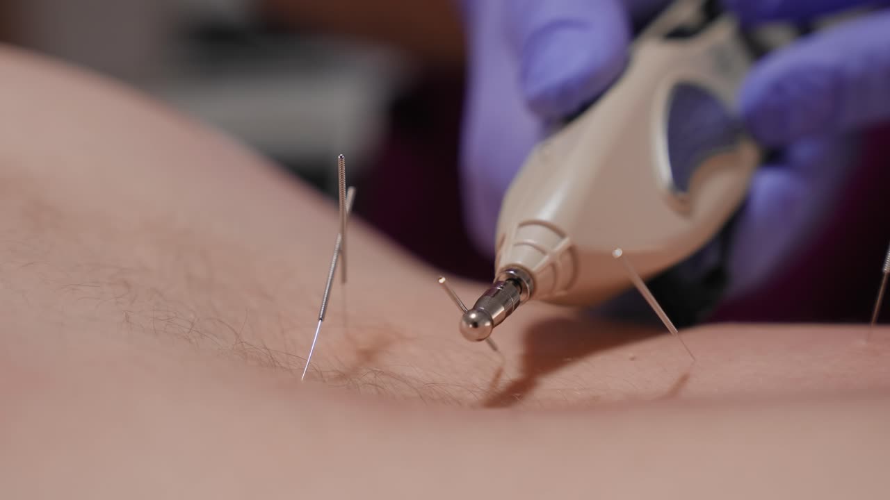 Macro close up of electric stimulator targeting acupuncture needles on skin during therapy