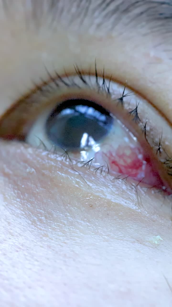 Primo piano estremo di un occhio umano irritato e iniettato di sangue che sbatte lentamente le palpebre sotto una luminosa illuminazione clinica.