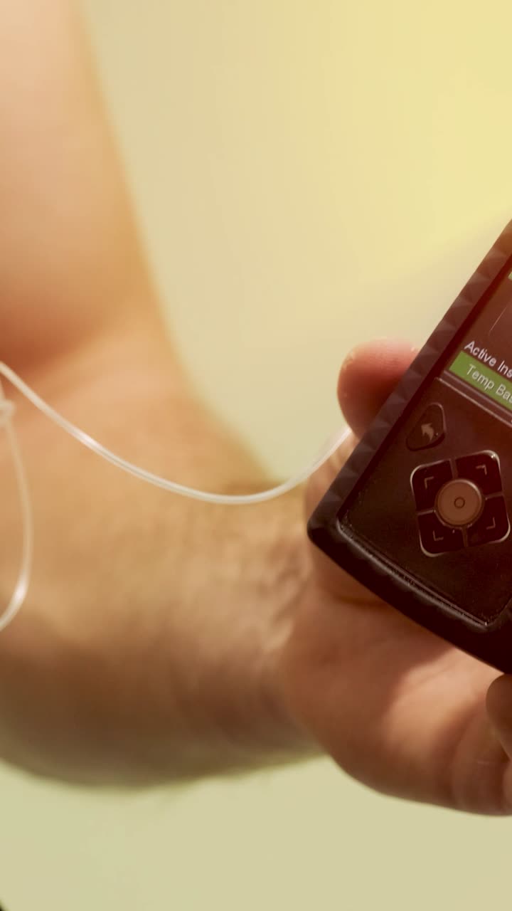 Primo piano di una persona che utilizza una pompa per insulina per la gestione del diabete