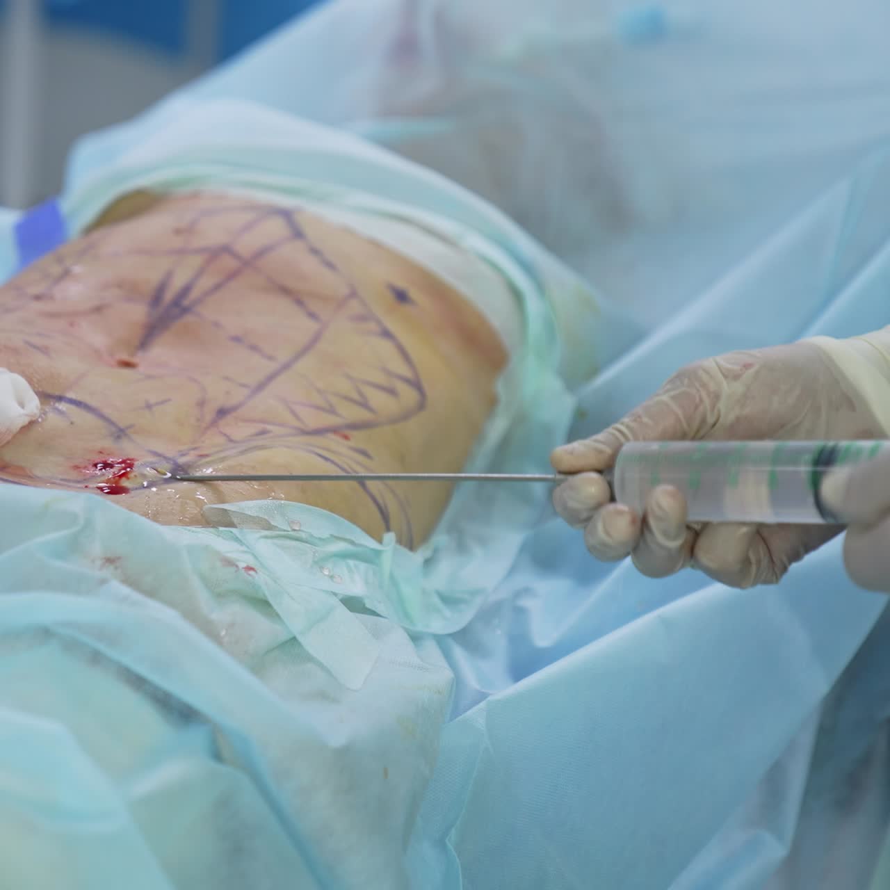 Surgeon's hands collects fat into pipe. Liposuction procedure for improvement patient's body. Medicine concept. Close-up